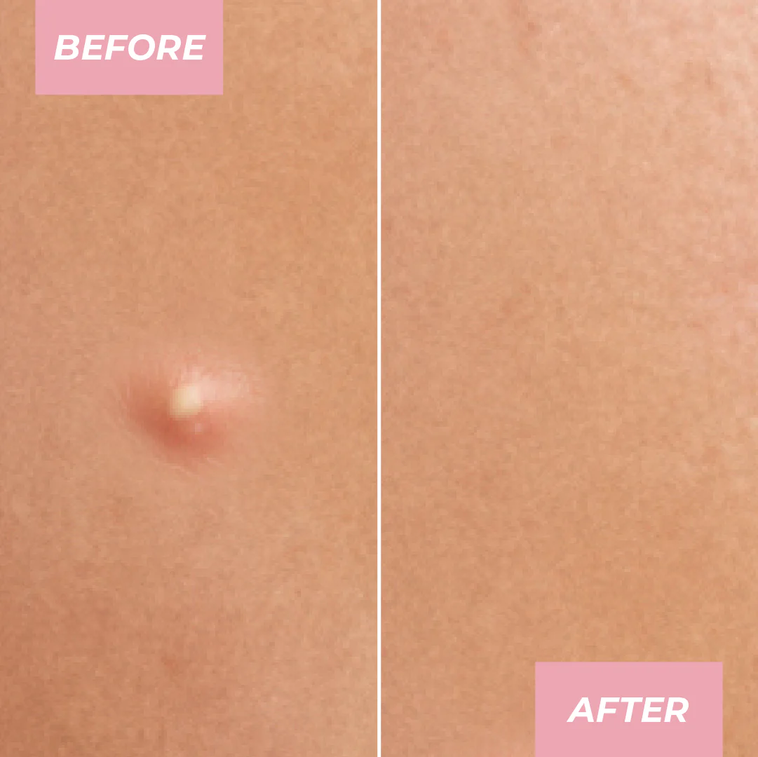 Miracle Pimple Patch - Image 7